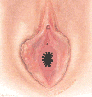 imene denticolare