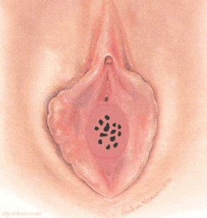 imene microperforato