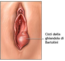 Cisti della ghiandola di Bartolini