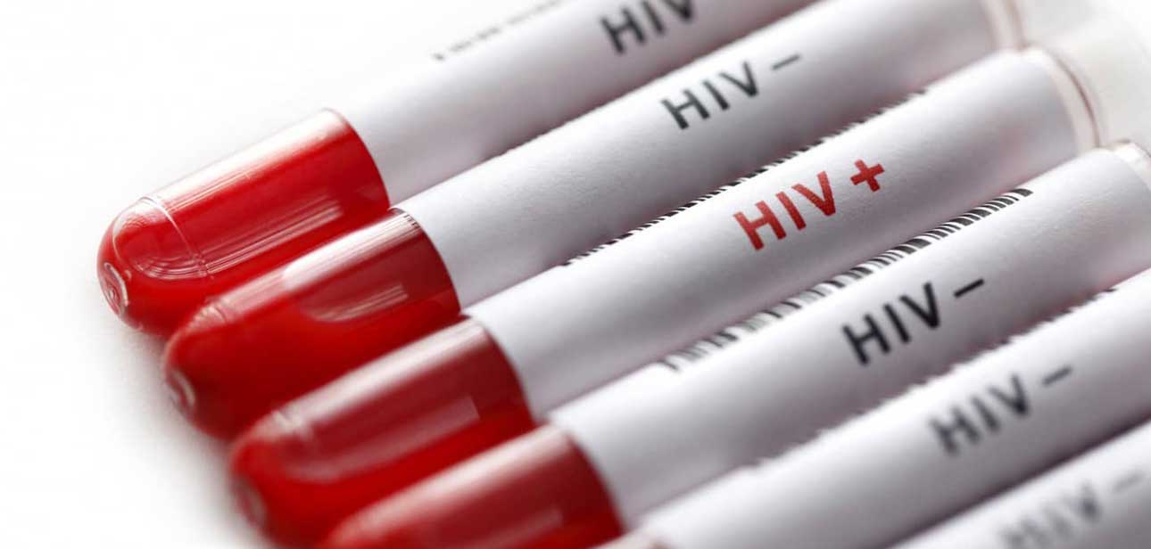 sieropositività da hiv e aids
