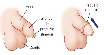 Prevenire l'AIDS con la circoncisione