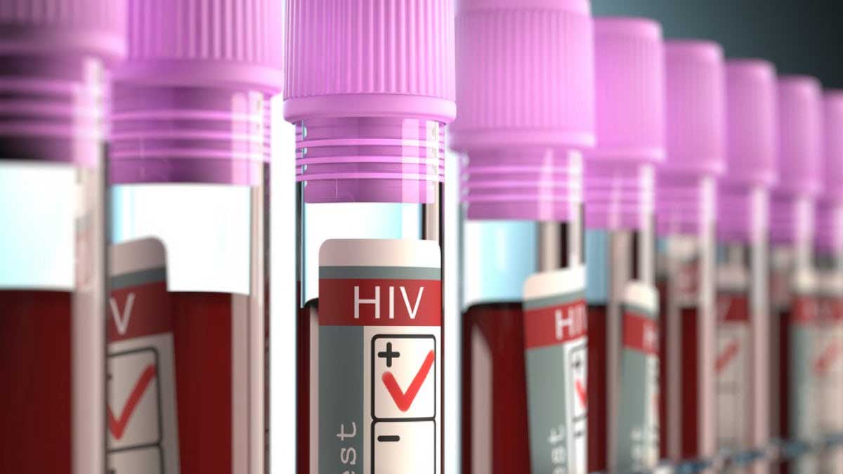 come si contrae il virus hiv